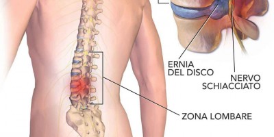 Ernia discale ed Impotenza